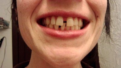 Niềng răng để khắc phục răng thưa