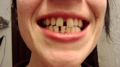 Niềng răng để khắc phục răng thưa