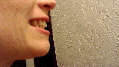 Niềng răng để khắc phục răng thưa