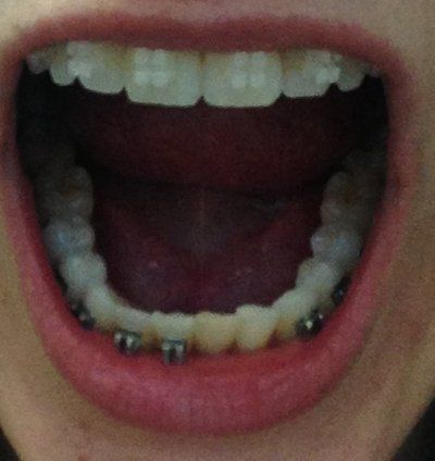 Niềng răng truyền thống để chữa răng khấp khểnh và một số tip