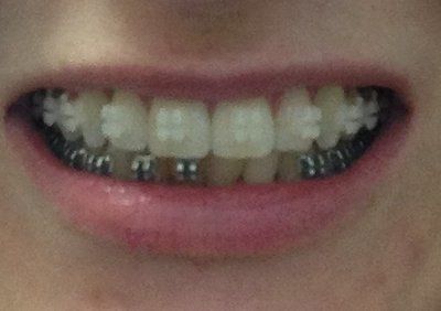 Niềng răng truyền thống để chữa răng khấp khểnh và một số tip