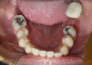 Trải nghiệm về quá trình niềng răng