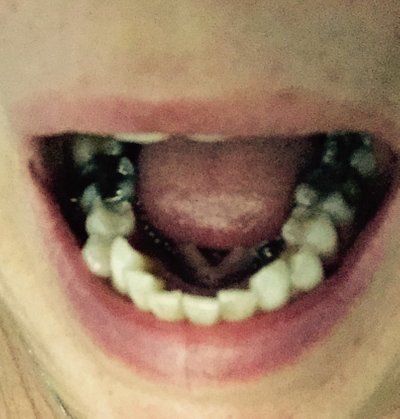 Niềng răng ở tuổi 50