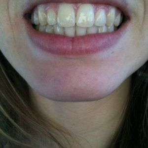 Cách chỉnh sửa răng cửa bị to?