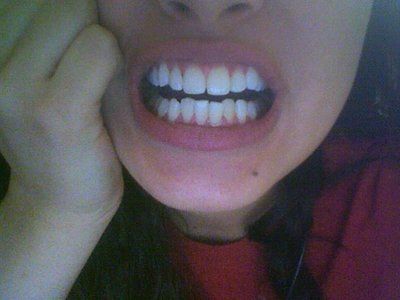 Lựa chọn niềng răng truyền thống hay niềng Invisalign đối với răng khấp khểnh, thưa và khớp cắn sâu?