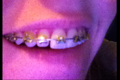 Niềng răng kim loại hiệu quả nhanh hơn và tốt hơn