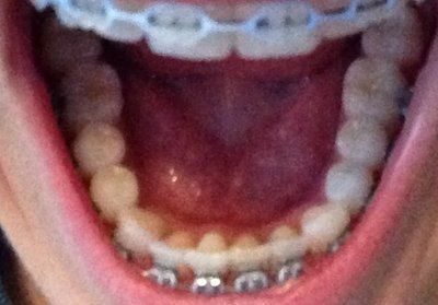 Niềng răng truyền thống để chữa răng khấp khểnh và một số tip