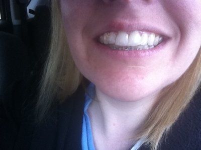 Niềng răng kim loại hiệu quả nhanh hơn và tốt hơn