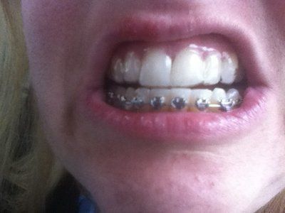 Niềng răng kim loại hiệu quả nhanh hơn và tốt hơn