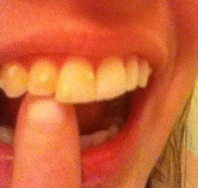 Niềng răng kim loại hiệu quả nhanh hơn và tốt hơn