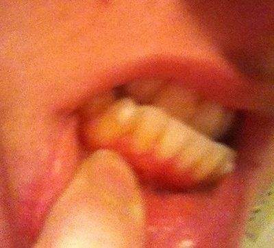 Niềng răng kim loại hiệu quả nhanh hơn và tốt hơn