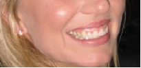 Tôi có nên phẫu thuật cười hở lợi trước khi bọc răng sứ/dán sứ Veneer không?