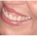 Tôi có nên phẫu thuật cười hở lợi trước khi bọc răng sứ/dán sứ Veneer không?
