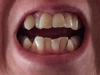 Nắn chỉnh răng bằng niềng Invisalign ở tuổi 53
