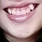 Tôi cần làm gì để điều trị răng khấp khểnh và cười hở lợi?