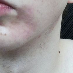 Cần làm gì khi da bị đỏ sau khi điều trị bằng laser CO2?