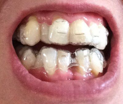 Nắn chỉnh răng bằng niềng Invisalign ở tuổi 53