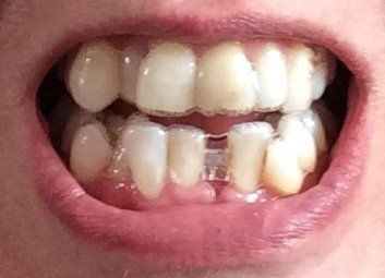 Nắn chỉnh răng bằng niềng Invisalign ở tuổi 53