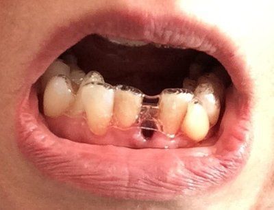 Nắn chỉnh răng bằng niềng Invisalign ở tuổi 53