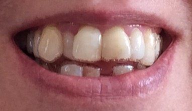 Nắn chỉnh răng bằng niềng Invisalign ở tuổi 53