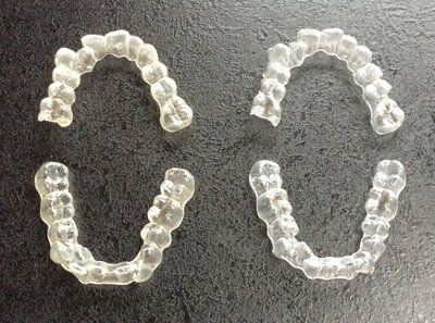 Nắn chỉnh răng bằng niềng Invisalign ở tuổi 53