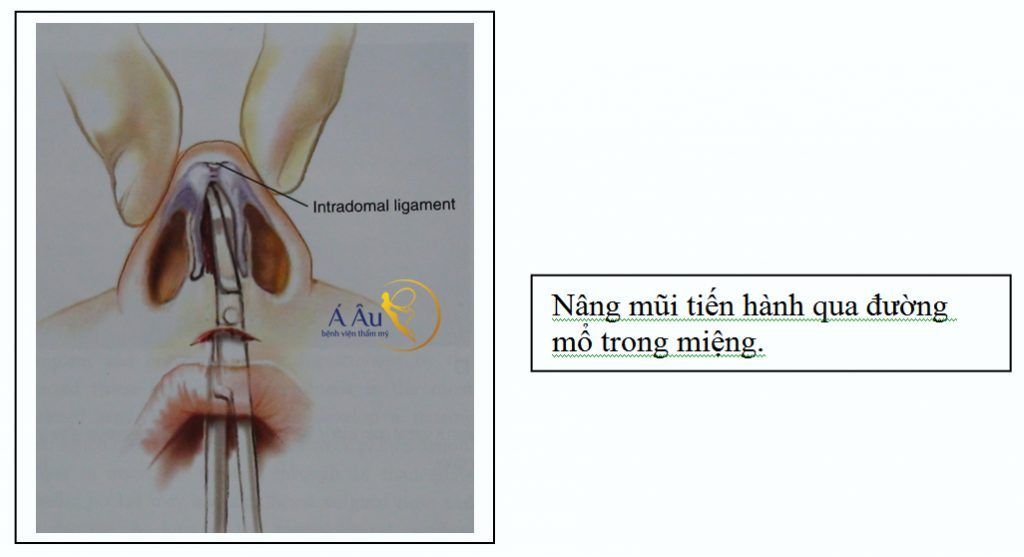 tin 43 ảnh 3 mổ qua đường miệng