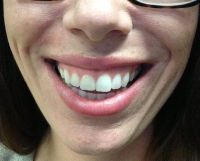 Có những phương pháp nào để chữa cười hở lợi?