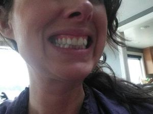 Nên phẫu thuật lợi bằng laser hay tiêm Botox để khắc phục cười hở lợi?