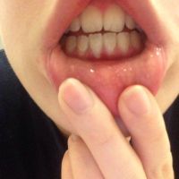 20 tuổi đã bị tụt lợi thì nên làm gì?