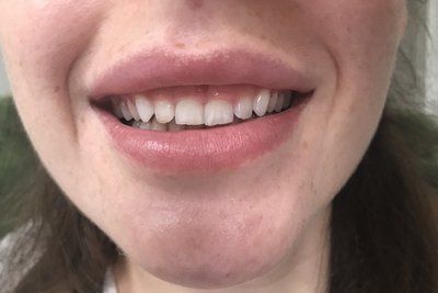Tạo hình lợi bằng laser hay phẫu thuật làm dài thân răng để chữa cười hở lợi?