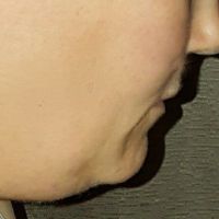 Tôi cần hút mỡ cằm hay căng da cổ?