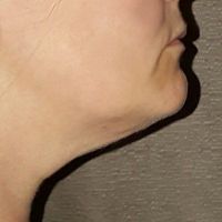 Tôi cần hút mỡ cằm hay căng da cổ?