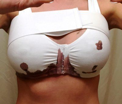 Nâng ngực chảy xệ kết hợp đặt túi độn ở cô gái có bộ ngực chảy xệ di truyền, 32 tuổi, cao 1m62, nặng 53kg