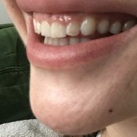 Tạo hình lợi bằng laser hay phẫu thuật làm dài thân răng để chữa cười hở lợi?