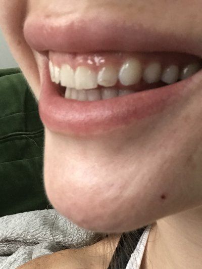 Tạo hình lợi bằng laser hay phẫu thuật làm dài thân răng để chữa cười hở lợi?