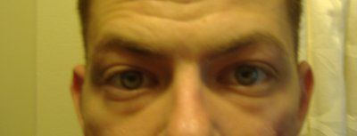 Bọng mắt của tôi là do tích nước hay mỡ? Bọng mắt của tôi là do tích nước hay mỡ?