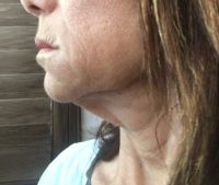 Căng da cổ sau khi đã căng da cho vùng dưới của mặt cách đây 20 năm