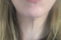 Tôi cần làm gì để cải thiện thừng cổ khi mới 37 tuổi?