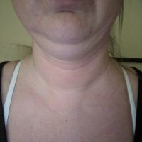 Cổ gà tây ở tuổi 30 thì có nên phẫu thuật căng da cổ không?