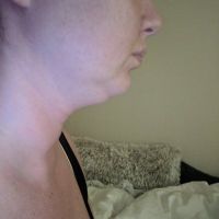 Cổ gà tây ở tuổi 30 thì có nên phẫu thuật căng da cổ không?