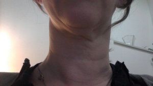 Cổ nhăn nheo, chảy xệ ở tuổi 39 thì nên làm gì?