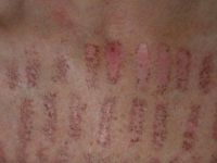 Có phải tôi bị giảm sắc tố sau điều trị IPL không? Có phải tôi bị giảm sắc tố sau điều trị IPL không?