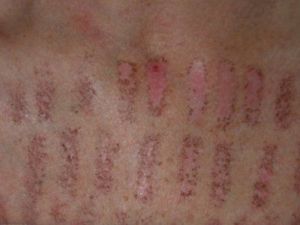 Có phải tôi bị giảm sắc tố sau điều trị IPL không?