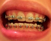 Có thể phẫu thuật cắt lợi ngay sau khi tháo niềng răng không?