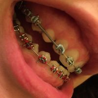 Có thể phẫu thuật cắt lợi ngay sau khi tháo niềng răng không?