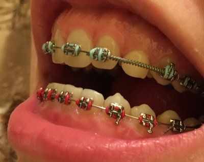 Có thể phẫu thuật cắt lợi ngay sau khi tháo niềng răng không?