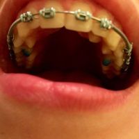 Có thể phẫu thuật cắt lợi ngay sau khi tháo niềng răng không?