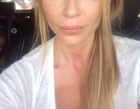 Loại filler nào là tốt nhất để làm đầy má hóp ở tuổi 40?