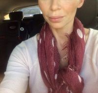 Loại filler nào là tốt nhất để làm đầy má hóp ở tuổi 40?