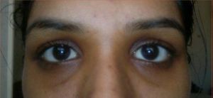 Làm thế nào để khắc phục tình trạng mắt trũng sâu?